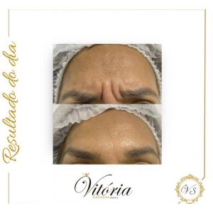 Botox Facial Para Rejuvenescimento - Vitória Stetic - (SP)